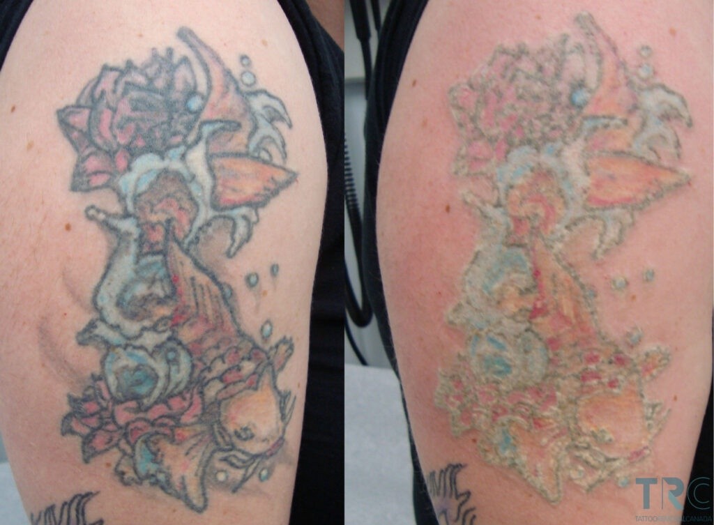 Side-by-side comparison of a tattoo before and after fading